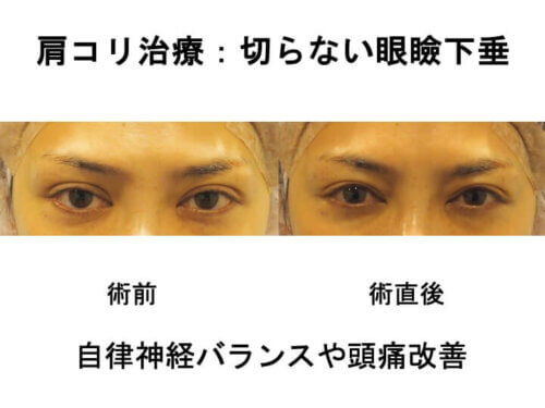 自律神経バランスや頭痛改善