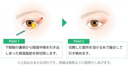下眼瞼脂肪除去の術式