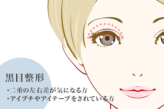 黒目整形 二重まぶた 眼瞼下垂 切開なし 切らない眼瞼下垂と眉下切開の東京皮膚科 形成外科 日本橋院