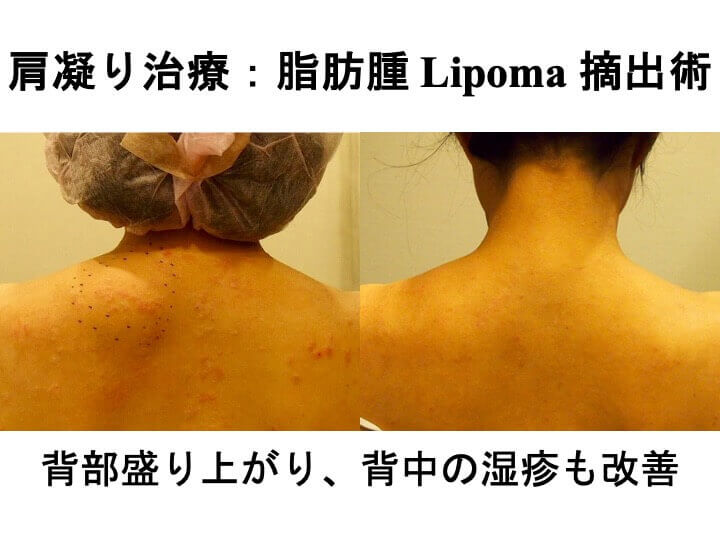 背部盛り上がり、背中の湿疹も改善