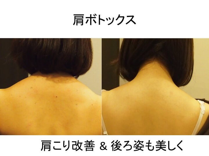 肩こりボトックス