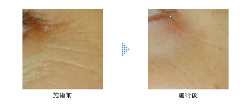 Genesis（ジェネシス）症例