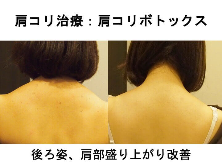 後ろ姿、肩部盛り上がり改善