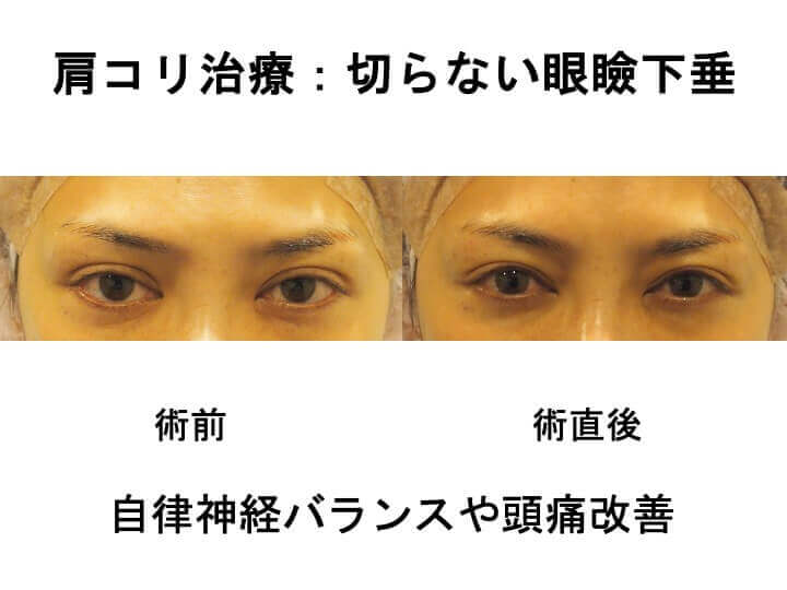 自律神経バランスや頭痛改善