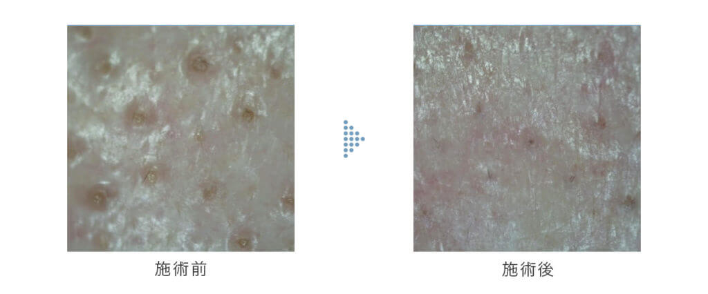 ハイドラジェントルで毛穴を綺麗に