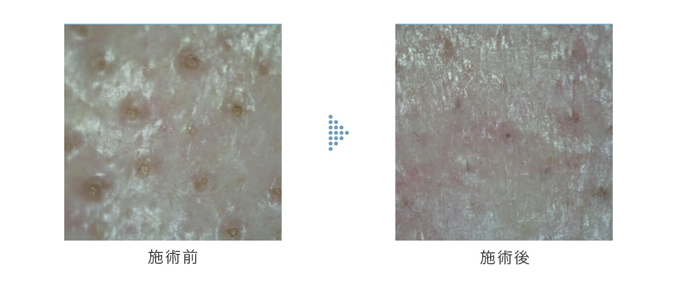 ハイドラジェントルで毛穴を綺麗に