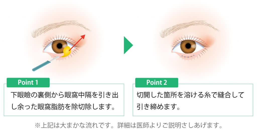 下眼瞼脂肪除去の術式