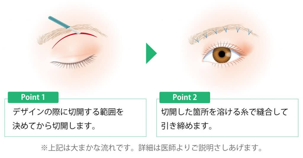 眉下切開の術式