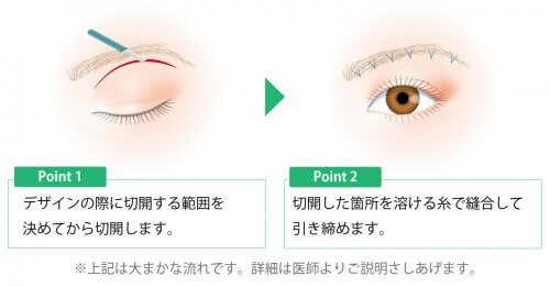 眉下切開の術式