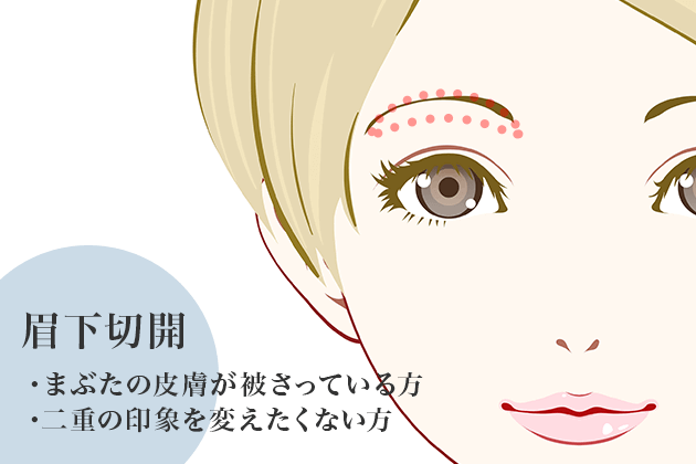 眉毛下皮膚切除術