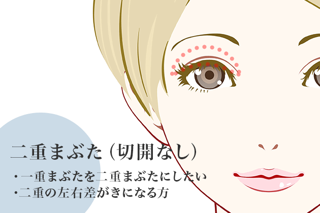 二重まぶた（切開なし）
