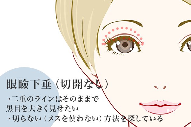 眼瞼下垂（切開なし）