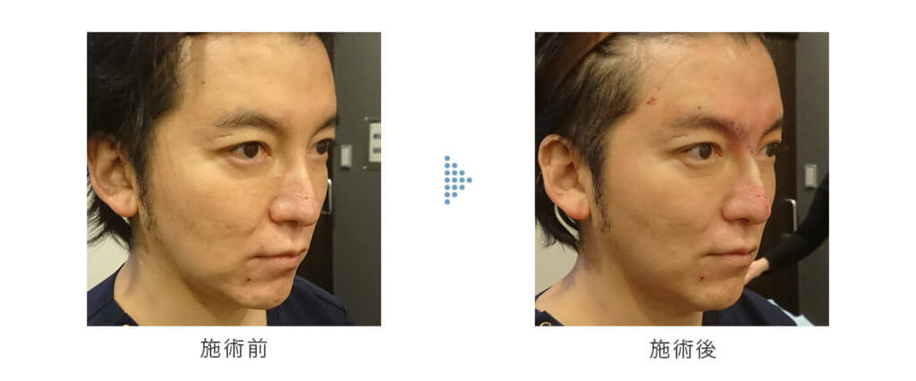 Gメッシュでほりを深く