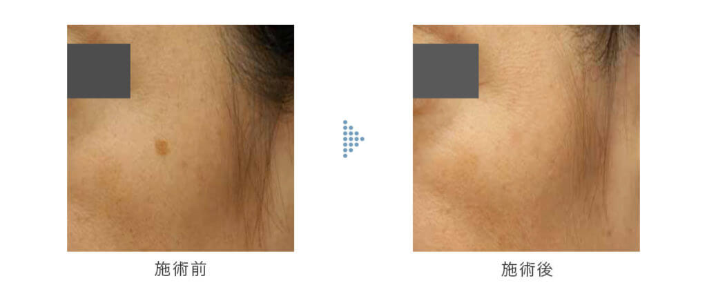 色素斑・シミの改善