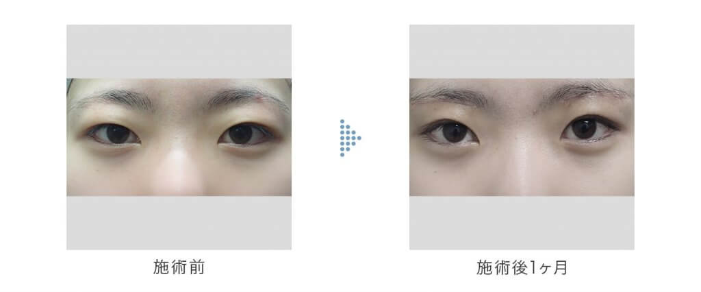 眉下切開の手術前と手術後
