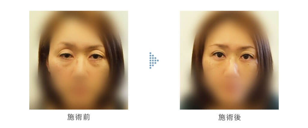 黒目整形NILTの症例写真