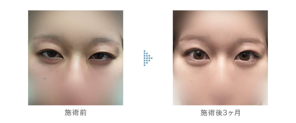 NILT2点両目の手術前と手術後