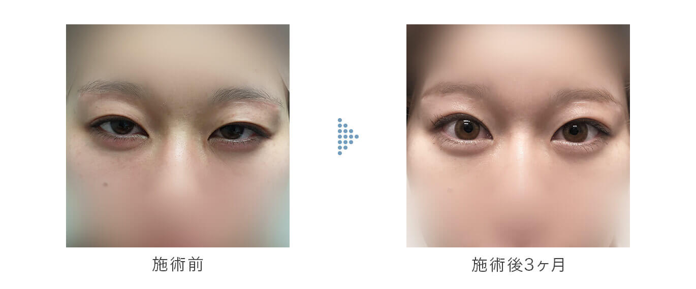 NILT2点両目の手術前と手術後