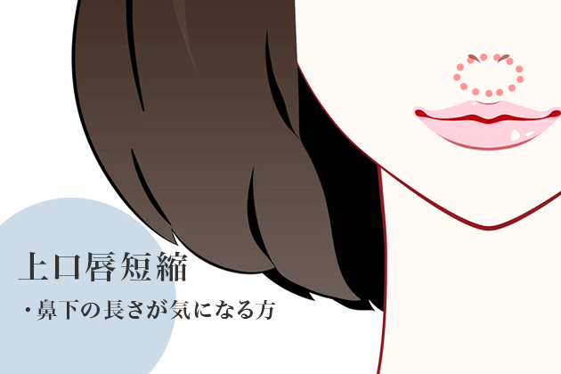 上口唇短縮
