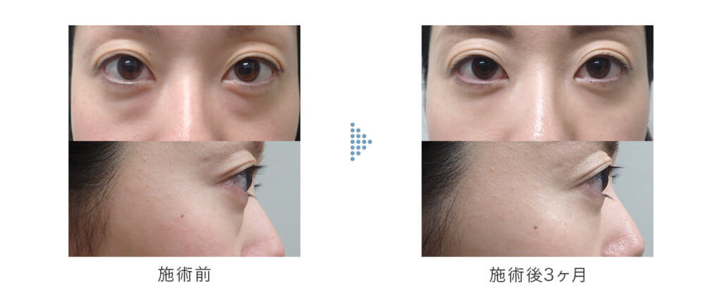 切らない下眼瞼