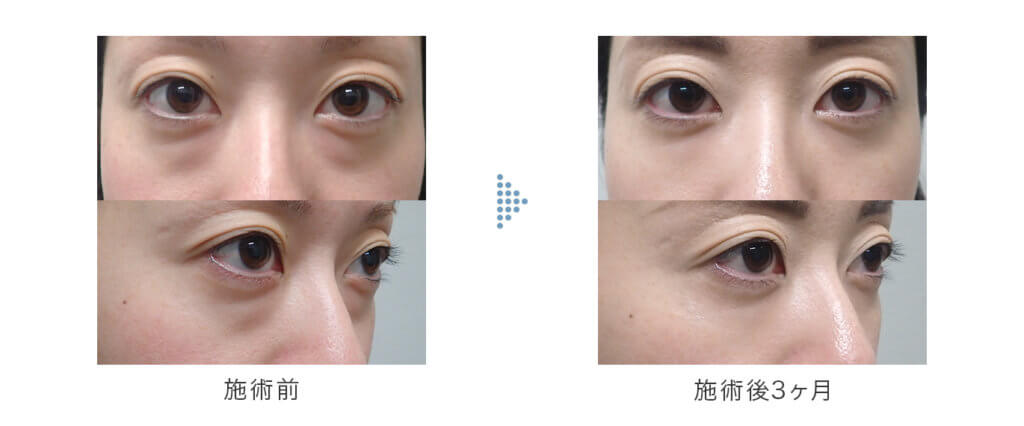 切らない下眼瞼