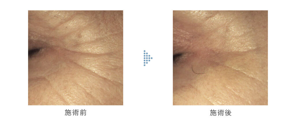 sunekos スネコス目元