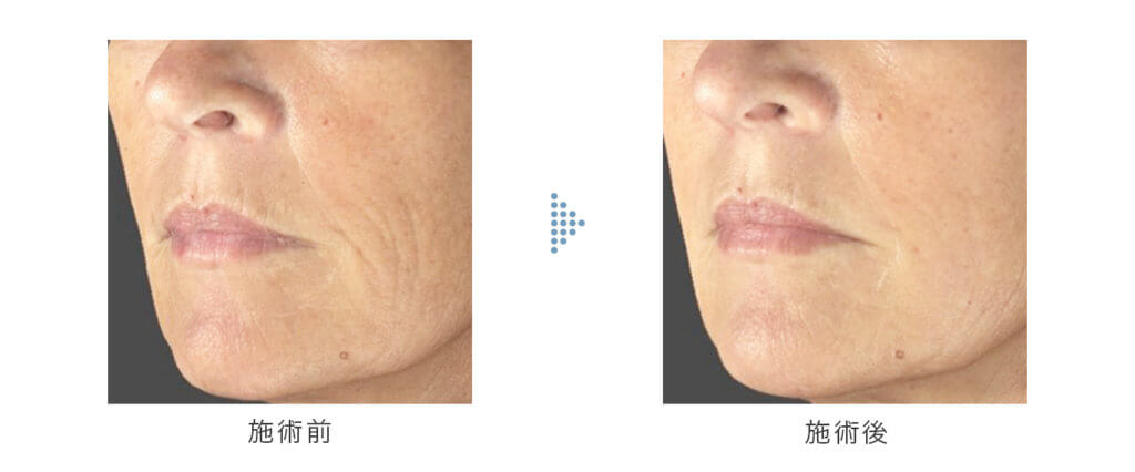 sunekosu スネコス口元