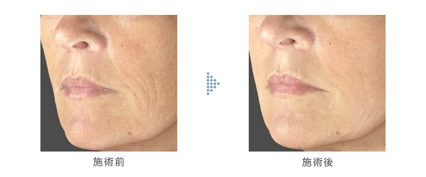 sunekosu スネコス口元