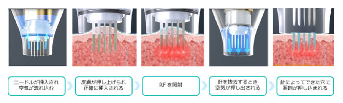POTENZAのドラッグデリバリーシステム