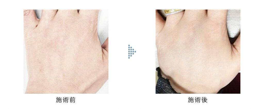 スネコス1cc手の甲