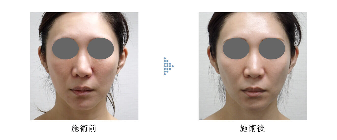 ゴウリ タイト 2cc