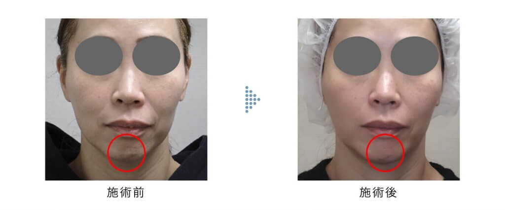 ゴウリ リフト 3cc