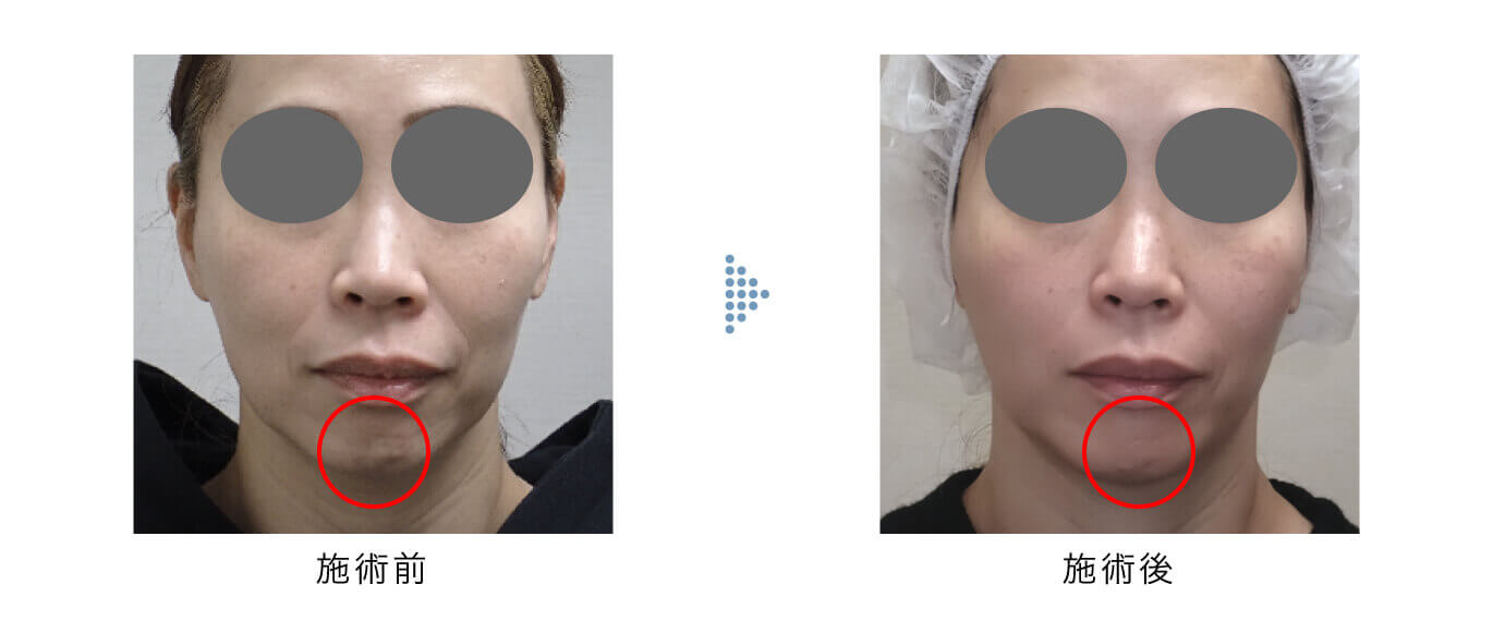 ゴウリ リフト 3cc