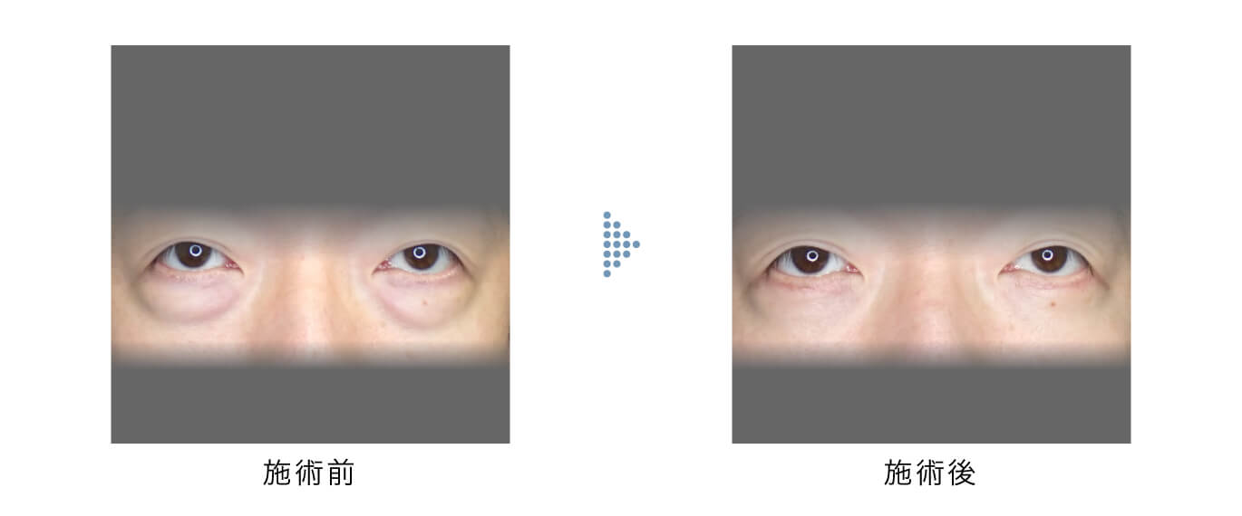 下眼瞼切開ハムラ症例