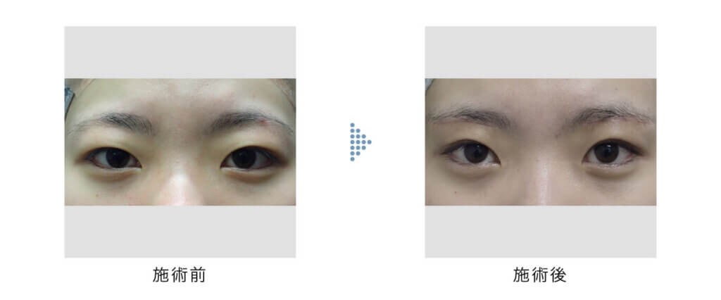 眉下切開の手術前と手術後