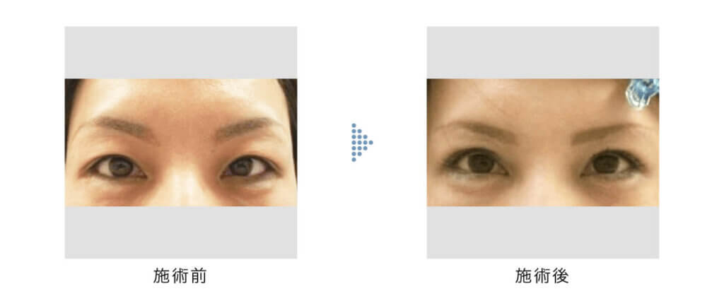 眉下切開の手術前と手術後