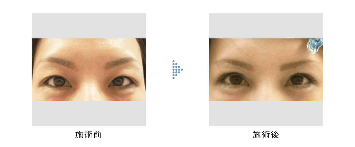 眉下切開の手術前と手術後