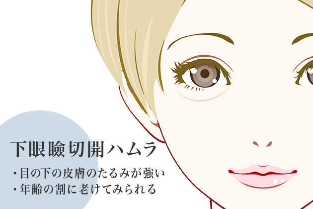 下眼瞼切開ハムラ法