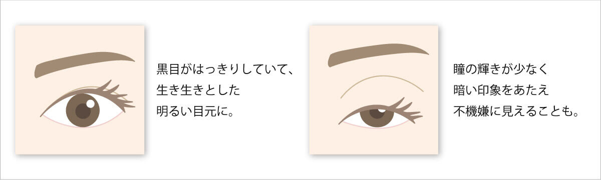 上まぶたのたるみ